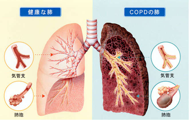 健康な肺とCOPOの肺