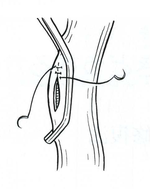 血管縫合糸