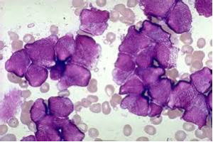白血病の細胞